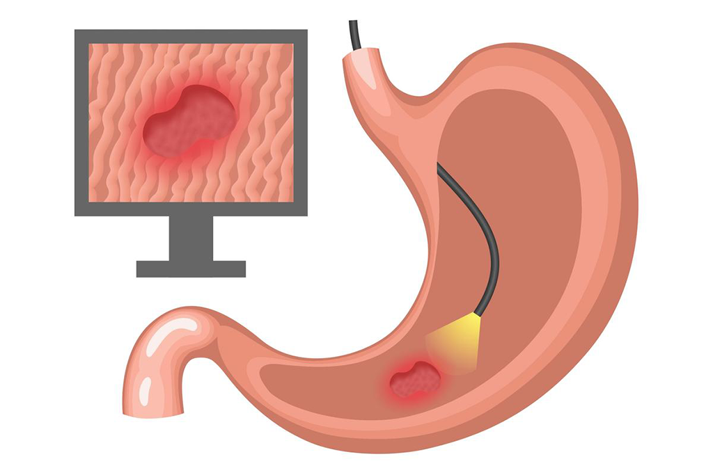 Endoscopy